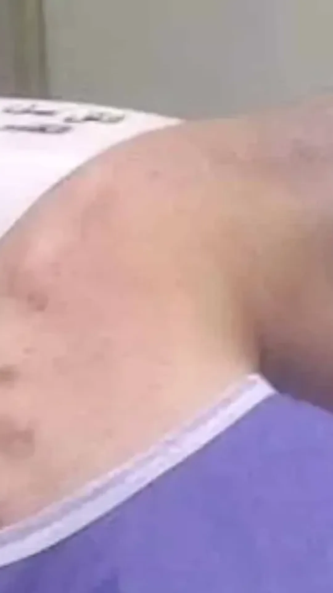 Homem sofre de rara síndrome da cabeça caída causada por vício