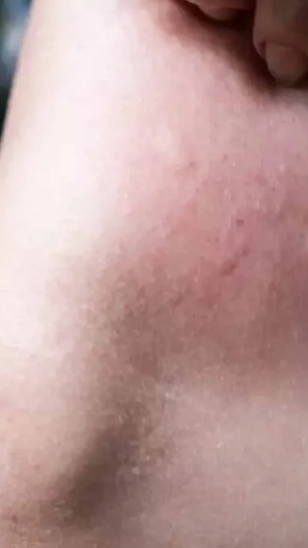 Mãe de 33 anos faz alerta após perceber que uma “picada de mosquito” era algo muito mais sinistro