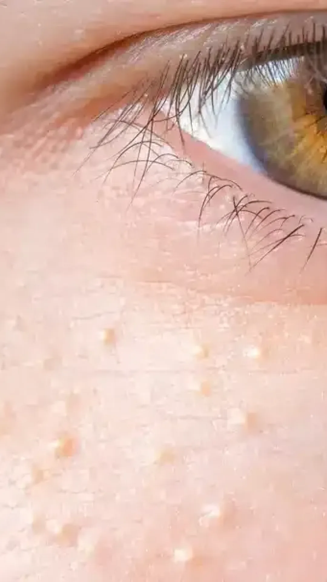 Médico explica como se livrar das pequenas manchas brancas que aparecem por todo o corpo