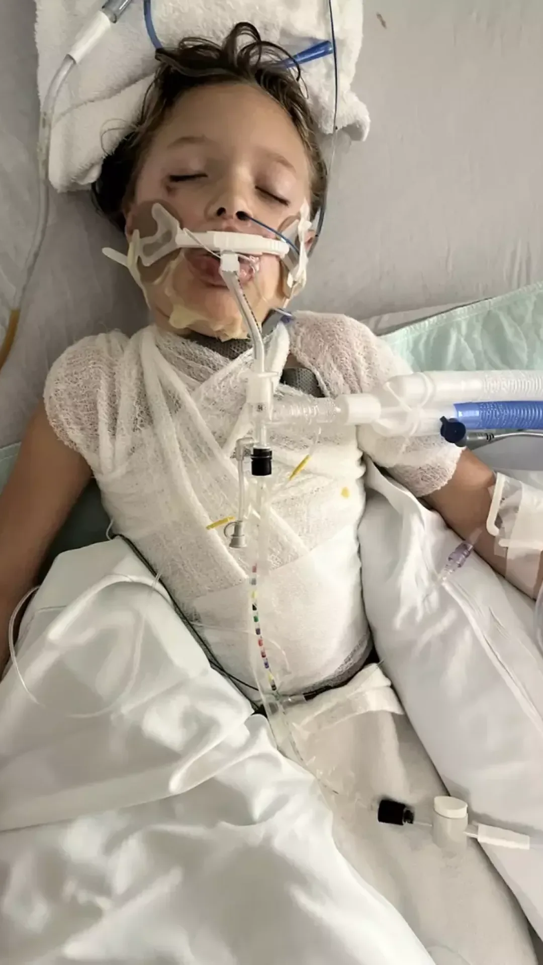 Menina de 7 anos fica em coma com ferimentos graves após brinquedo explodir em seu rosto enquanto tentava uma tendência que viu na internet
