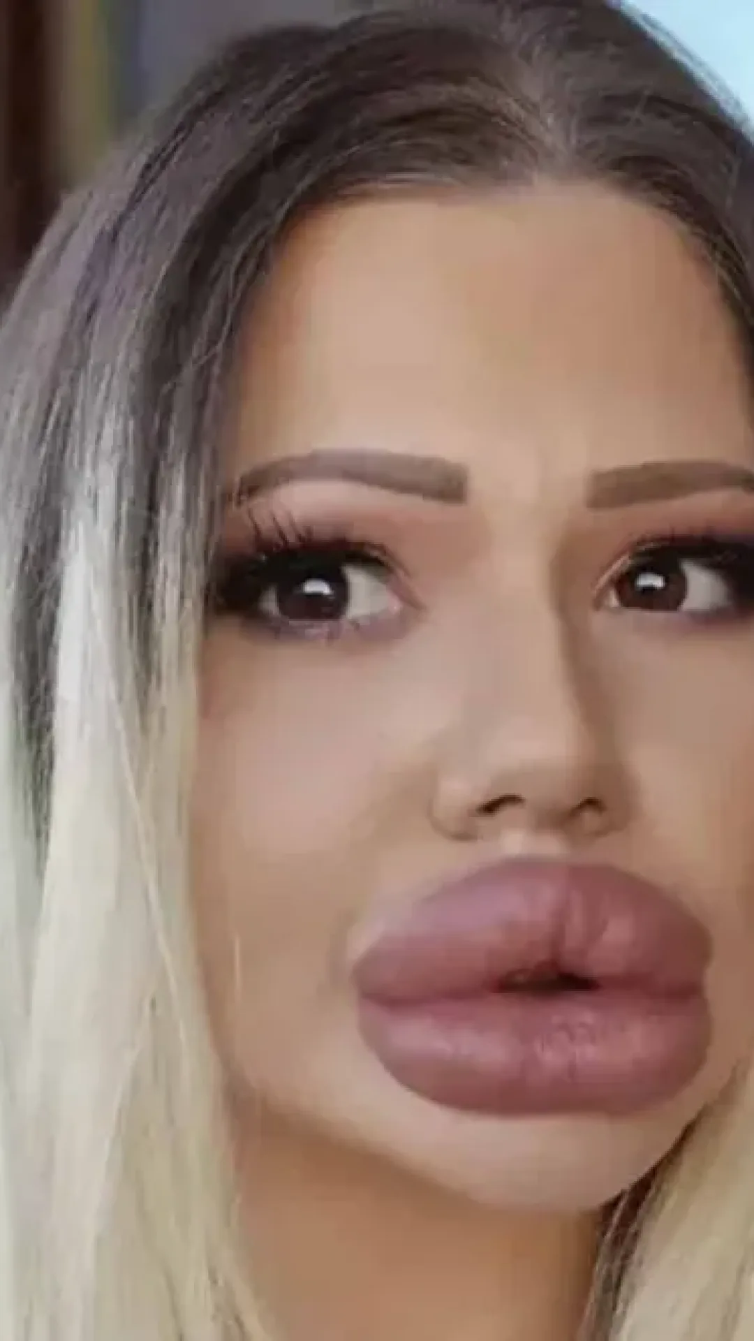 Mulher com os maiores lábios do mundo mostra como era antes das cirurgias