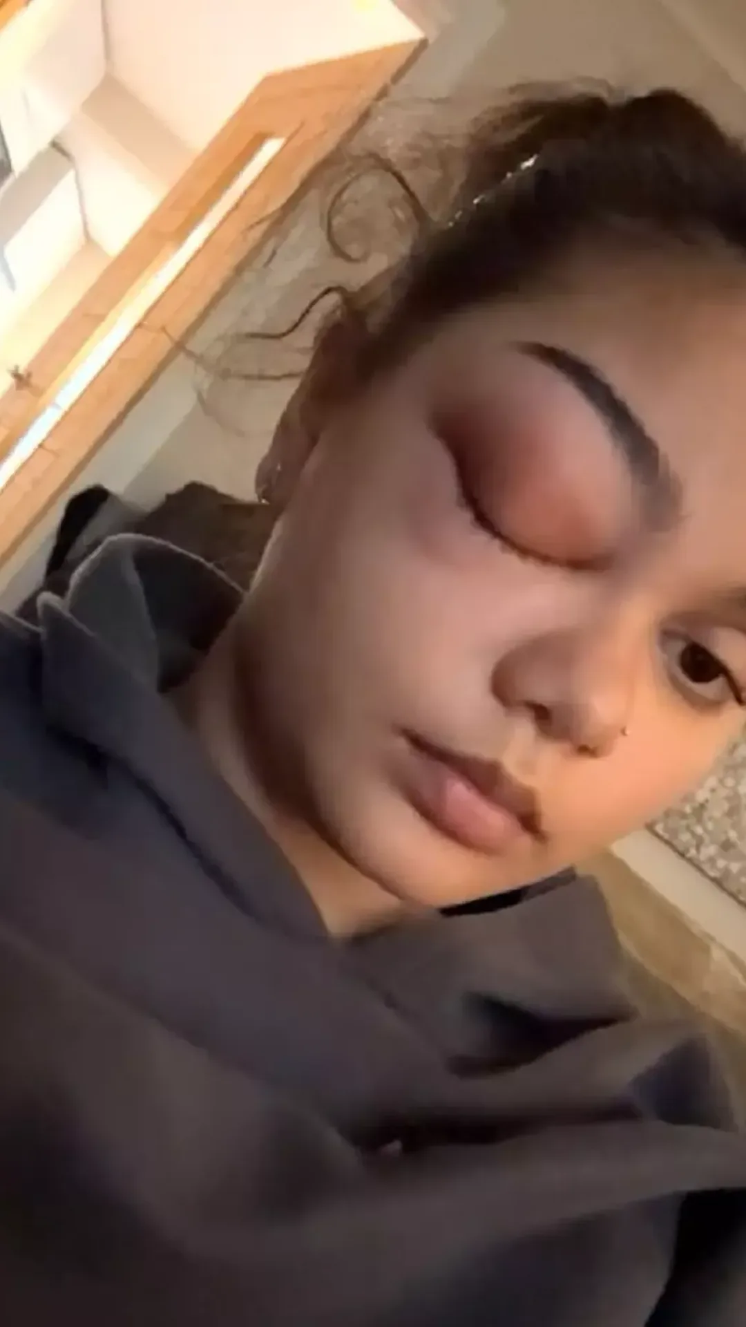 Mulher fica horrorizada ao descobrir por que não parava de esfregar o olho depois de pegar um resfriado