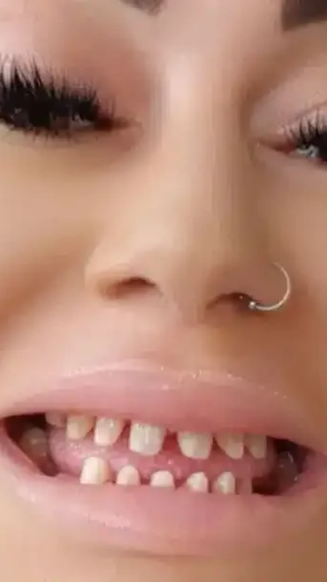 Mulher gastou R$ 120.000 em um procedimento dentário, mas ficou sem dentes e incapaz de comer