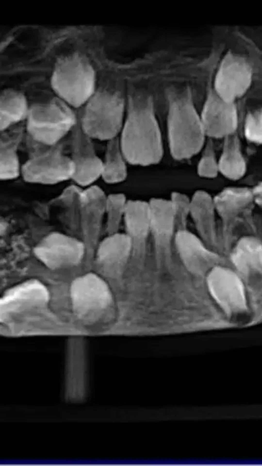 O incrível caso do menino de quem foram extraídos 526 dentes em uma única cirurgia