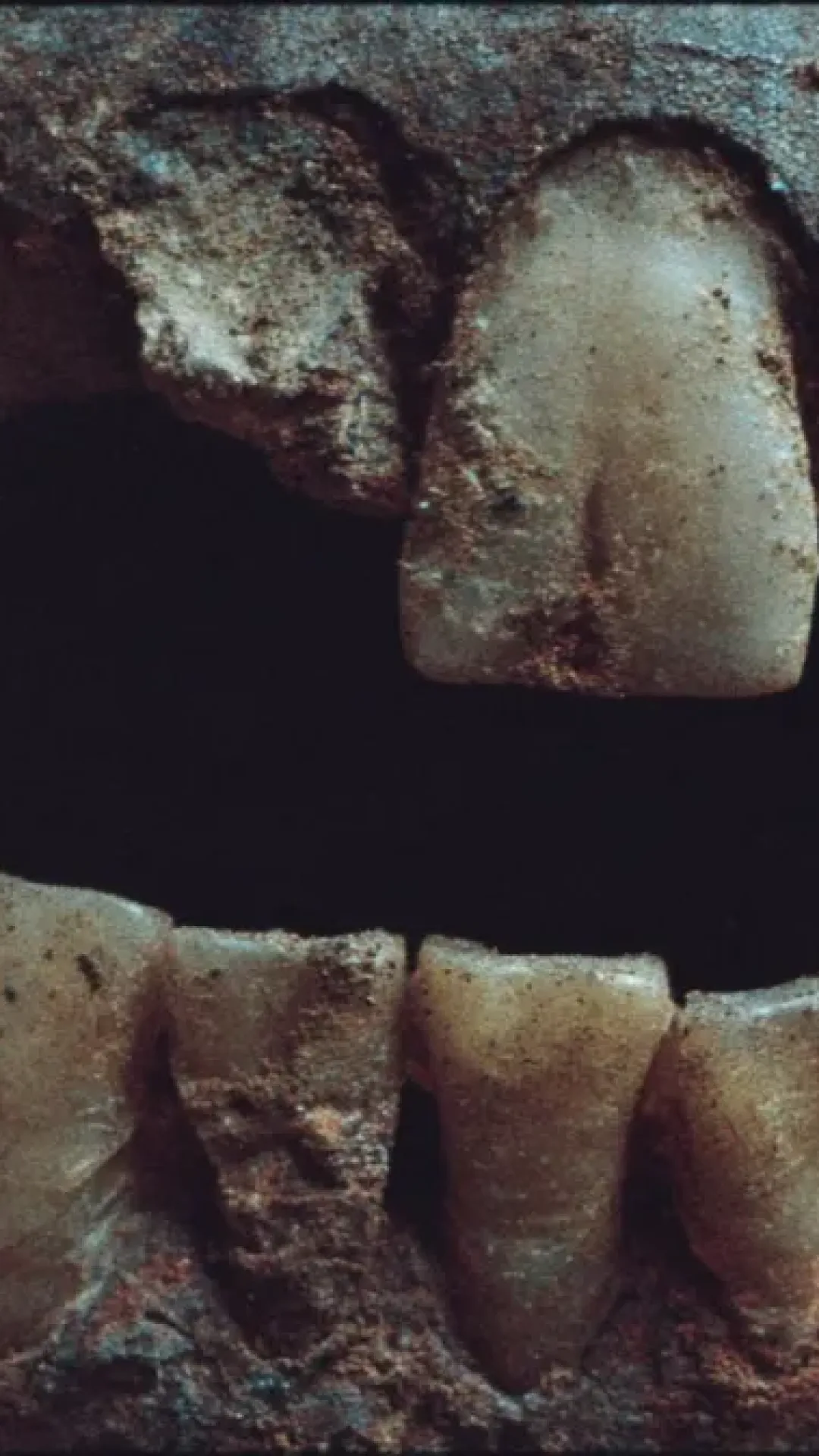 O que significa sonhar que os dentes estão caindo?