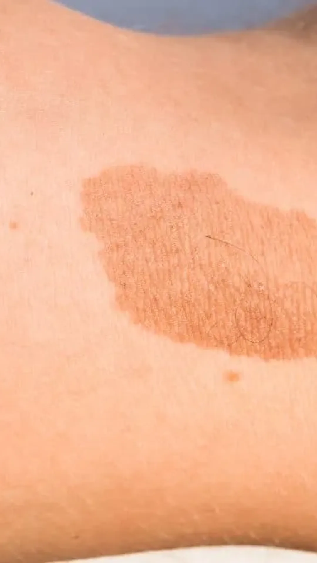 O que significa ter uma marca de nascença no corpo?