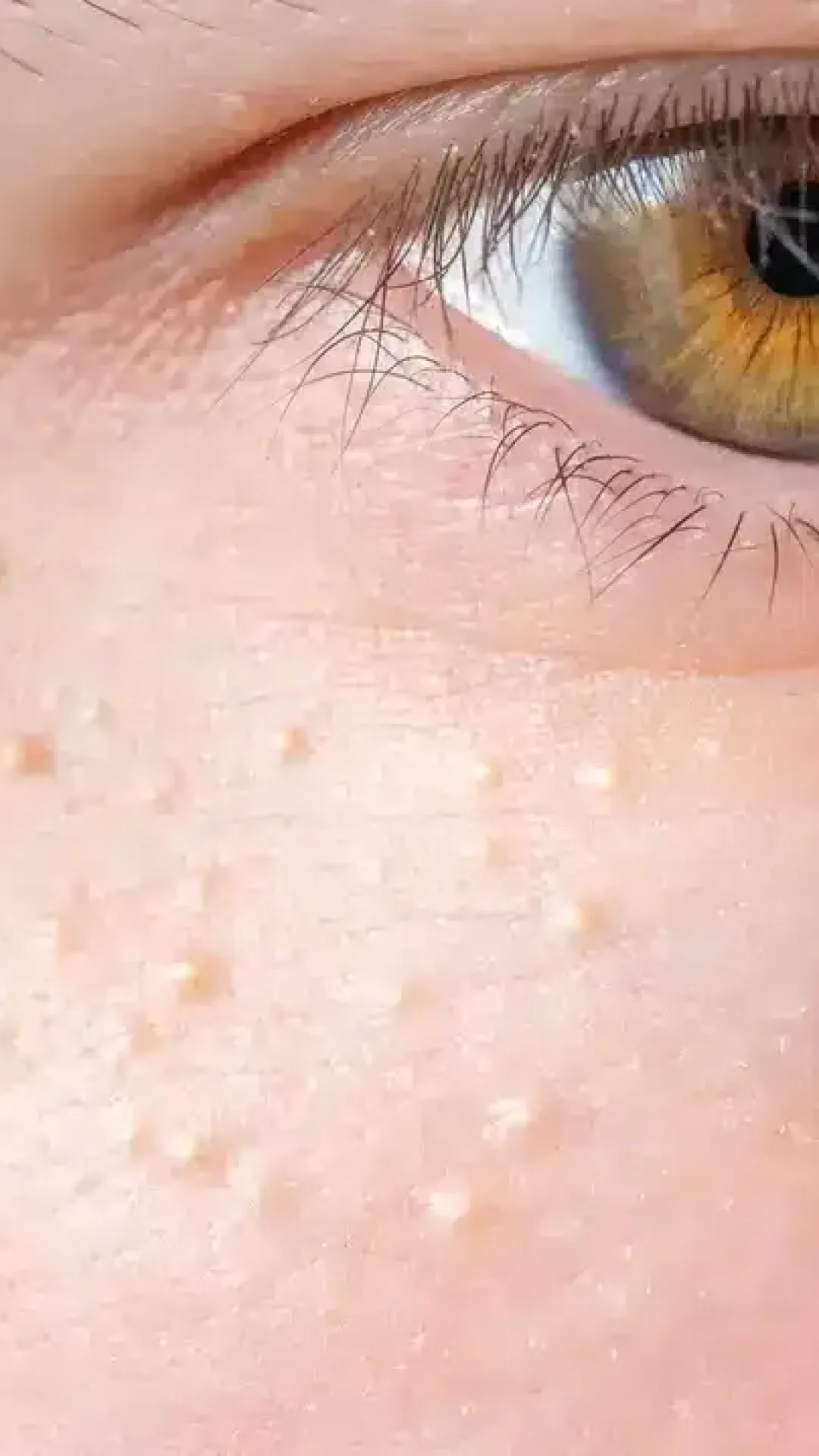 O significado por trás de pequenas bolinhas brancas que podem aparecer em todo o corpo, inclusive nas partes íntimas