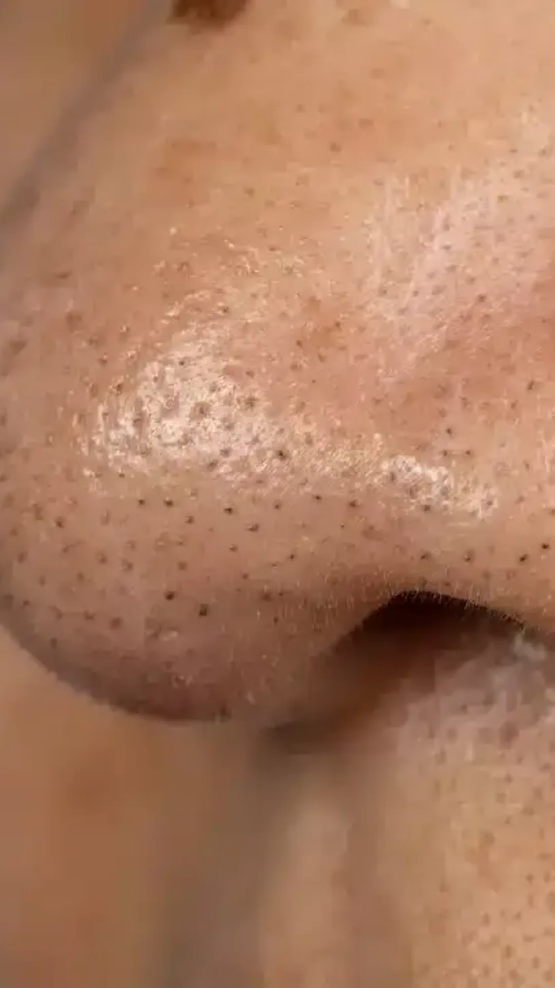 Qual é a diferença entre cravos e os pontinhos pretos do nariz, enquanto dermatologista alerta para não espremer