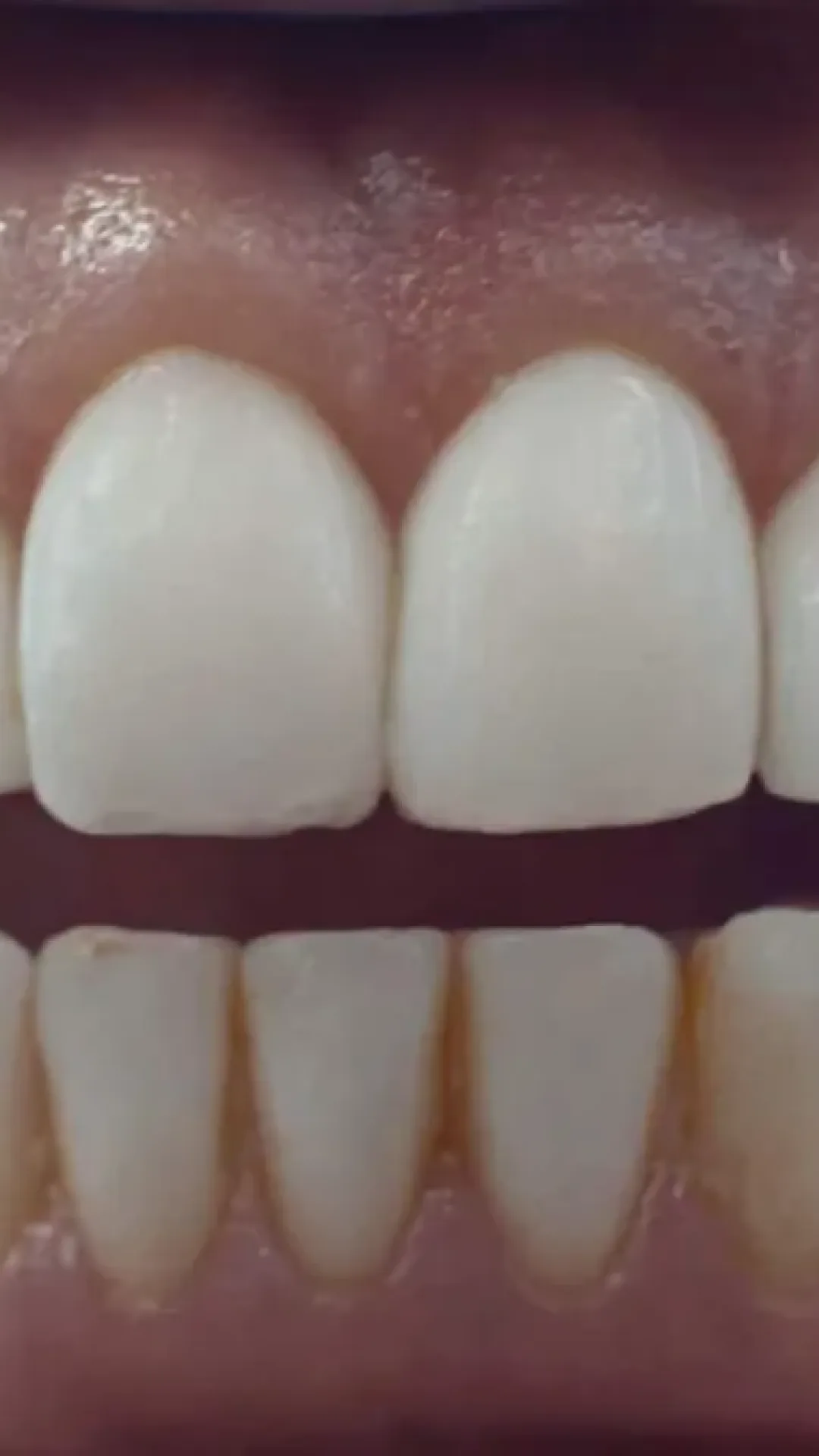 Simulação aterrorizante supostamente mostra exatamente o que aconteceria com seus dentes se você ficasse 30 dias sem escová-los