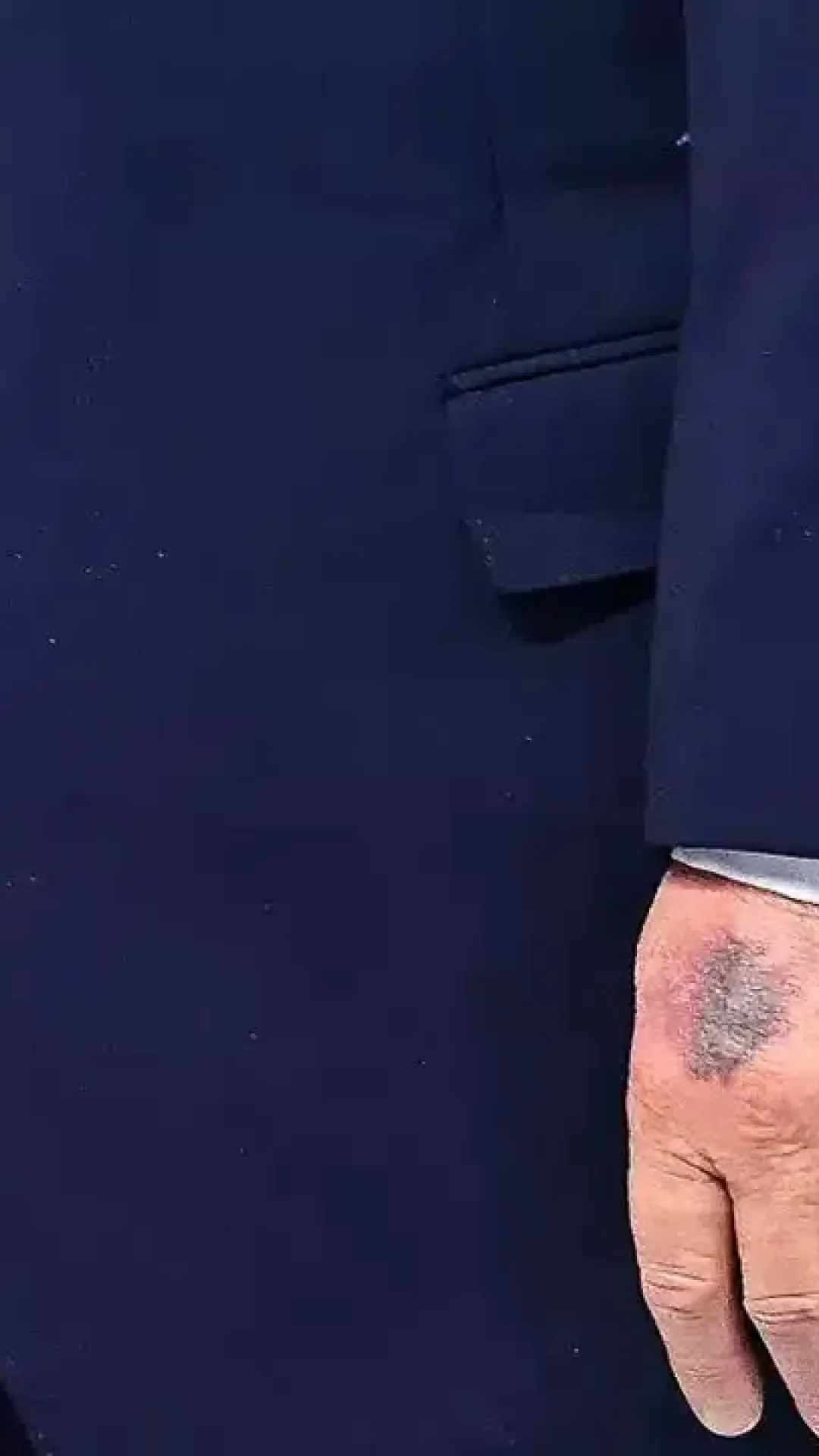 Trump explica o motivo do hematoma na mão após novas fotos despertarem preocupação